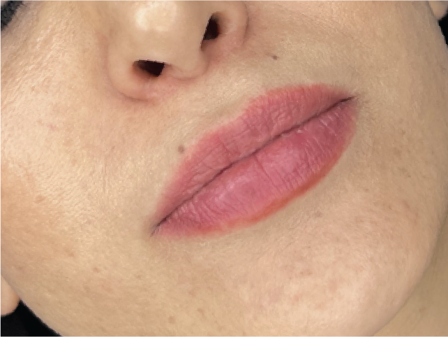 ژل لب یوسف اباد فیلر لب یوسف اباد کلینیک هلن